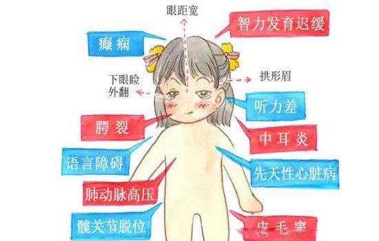 歌舞伎综合症患者图片 是什么病成年后真的漂亮吗