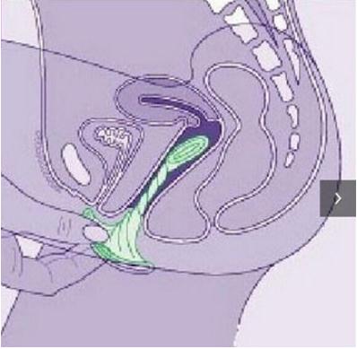 女用避孕套的使用方法 女用避孕套真人试戴大图