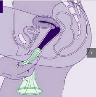 女用避孕套的使用方法 女用避孕套真人试戴大图