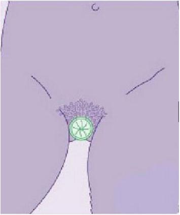 女用避孕套的使用方法 女用避孕套真人试戴大图