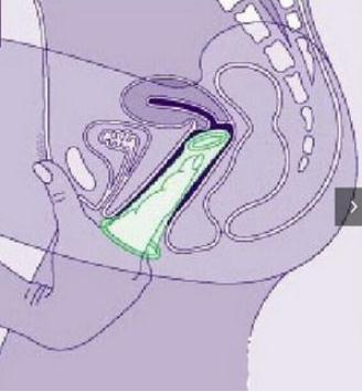 女用避孕套的使用方法 女用避孕套真人试戴大图