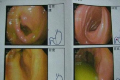 ​胆汁反流性胃炎该怎么治疗(胆汁反流性胃炎的治疗方法)