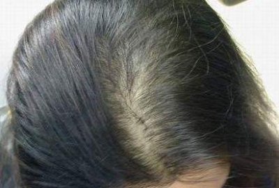 ​经常掉发会变成秃头吗(头发每天都在掉,我会变成秃头吗?)