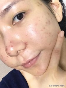 ​脸上长痘快速祛痘方法(脸上长痘痘如何快速去除)