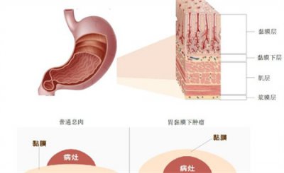 ​胃是怎样一步一步演变成癌变的？