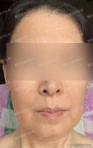 ​整容前后照片对比真人（来看看56岁姐姐做拉皮手术的亲身经历）