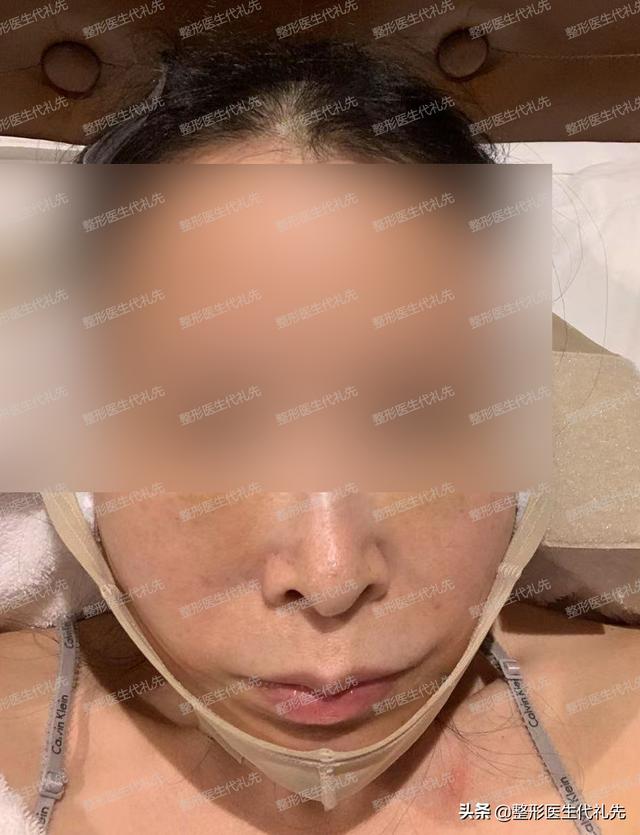 整容前后照片对比真人（来看看56岁姐姐做拉皮手术的亲身经历）