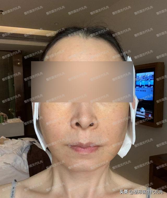 整容前后照片对比真人（来看看56岁姐姐做拉皮手术的亲身经历）