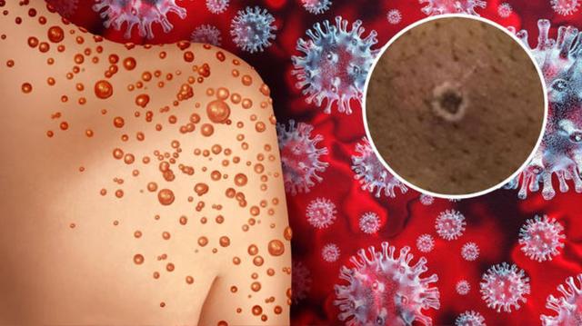 美国的猴痘是因为什么引起的（美国祸不单行）(1)