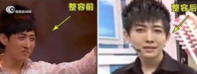 ​王亦丰整容，yif整容脸