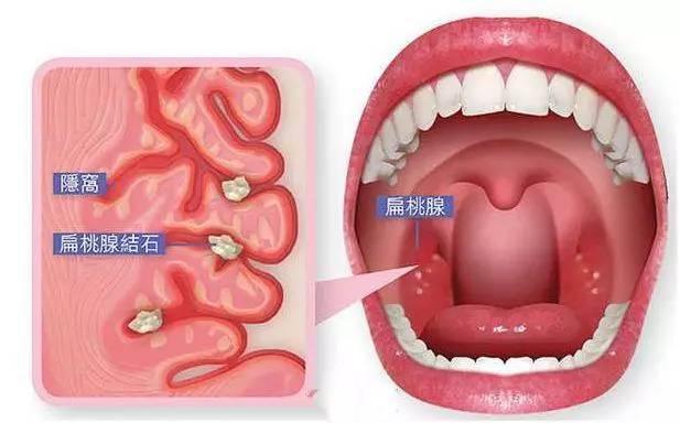 为什么戴口罩会闻到口臭（戴口罩时闻到的臭味是口臭么）(6)