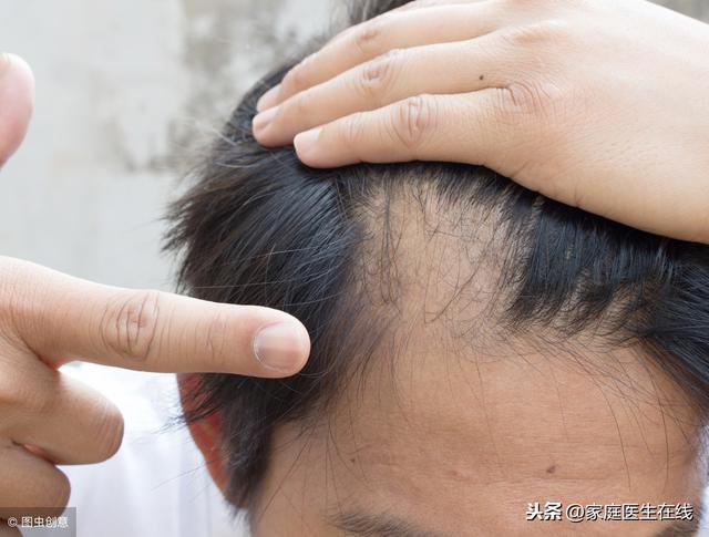 女性脱发发际线后移的原因有几种(拯救你的发际线)(1)