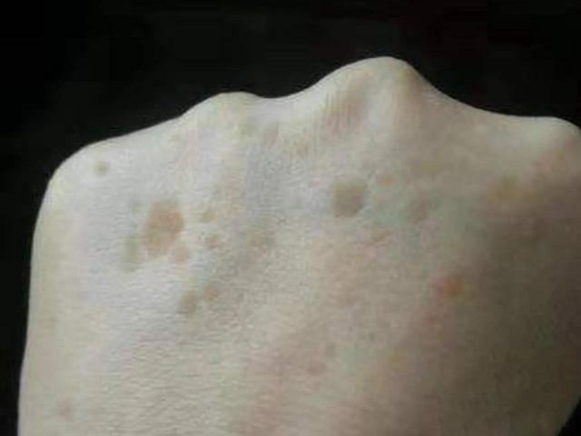 吃什么预防老年斑最有效的方法（坚持做到这四点）(2)