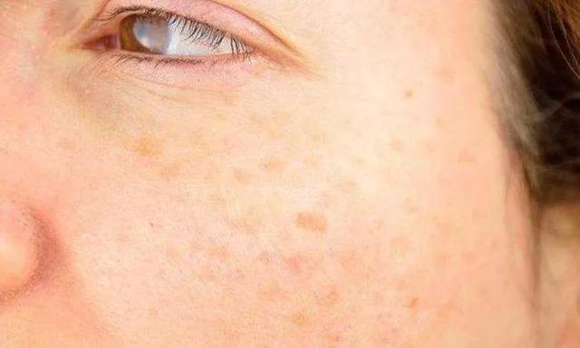 吃什么预防老年斑最有效的方法（坚持做到这四点）(3)