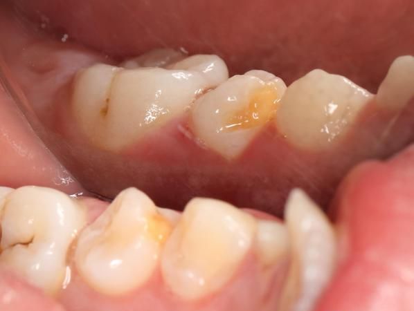 孩子乳牙蛀了需要补吗