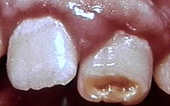 小孩子有蚜虫会影响以后牙齿生长吗