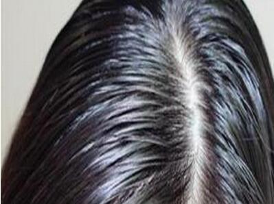 快速去头油小妙招（五个方法让你轻松去头油）(1)