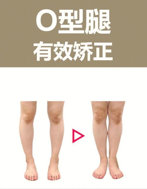 如何矫正o型腿（o型腿矫正的5种方法）