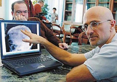 ​世界换头术首例成功的人怎么样了（实现2次成功连接）