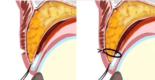埋线双眼皮的七天恢复过程图(埋线双眼皮3天就能恢复)(4)