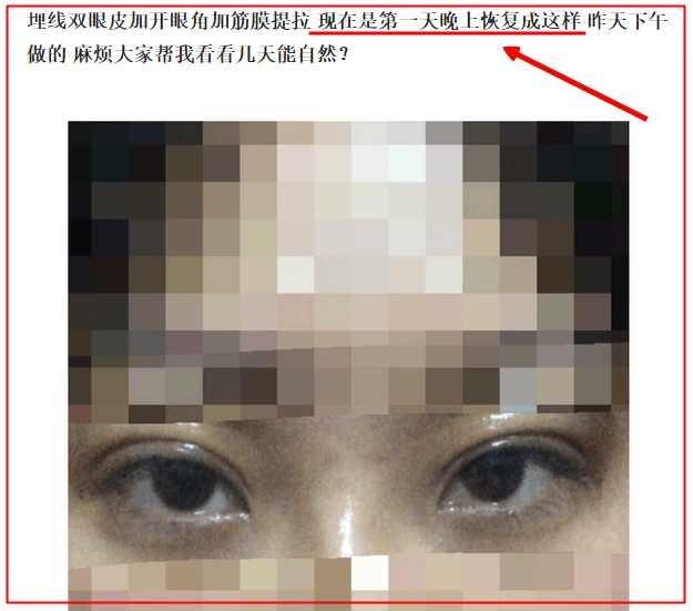埋线双眼皮的七天恢复过程图(埋线双眼皮3天就能恢复)(2)