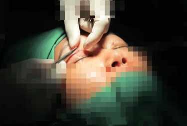 埋线双眼皮的七天恢复过程图(埋线双眼皮3天就能恢复)(1)