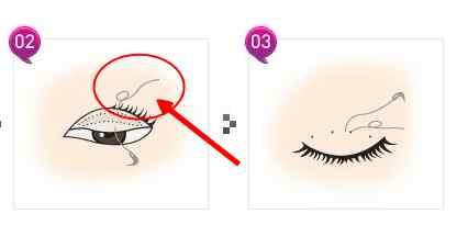 埋线双眼皮的七天恢复过程图(埋线双眼皮3天就能恢复)(5)