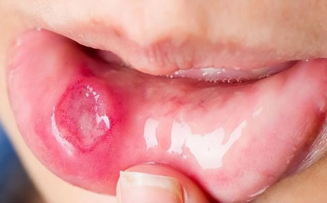 治疗口腔溃疡的12个小偏方（一个方子专治口腔溃疡）(1)