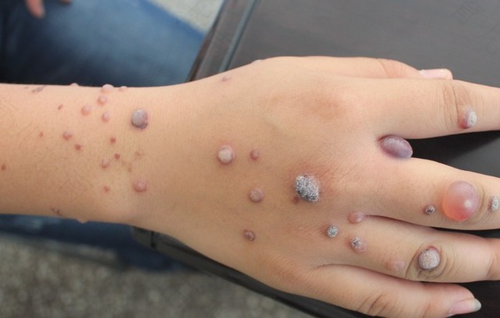 儿童寻常疣最佳治疗方法(寻常疣最佳治疗方法激光快吗)-第1张图片-