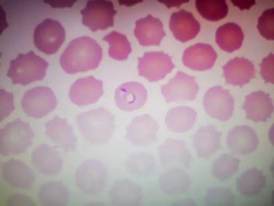 ​刚从非洲回来！浙江男子发热 4 天，吃药也没用，最终确诊……