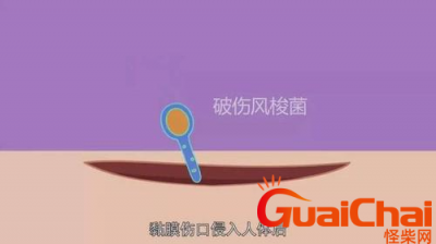 ​破伤风有哪三个征兆？破伤风有什么症状？