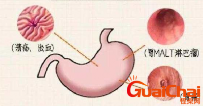 ​幽门螺旋杆菌有什么症状？吃什么药治疗？