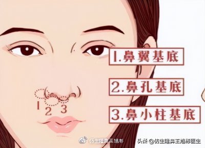 ​鼻翼法令纹 太天真！解决法令纹的4种方案，靠鼻基底填充就够了吗？