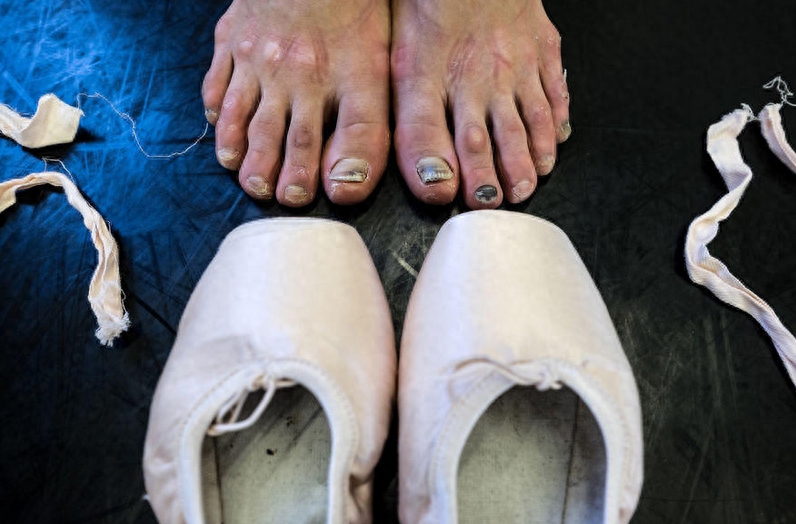 芭蕾舞者藏在舞鞋里的脚：结满老茧，严重变形