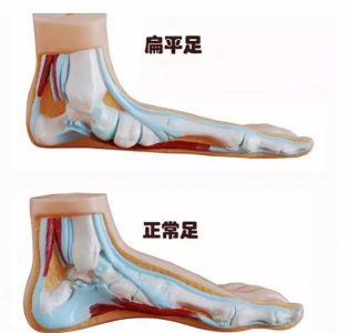 ​扁平足的危害 扁平足的危害大吗？来看看您的孩子是扁平足吗？