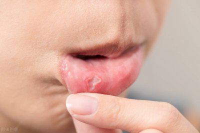 ​什么中药治疗口疮（口腔溃疡的“天敌”，这个广泛使用的中药都被我们忽略了）
