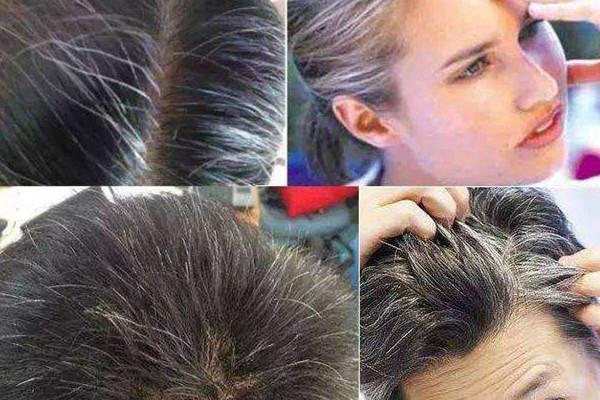 白头发可以拔吗 白头发解决方法