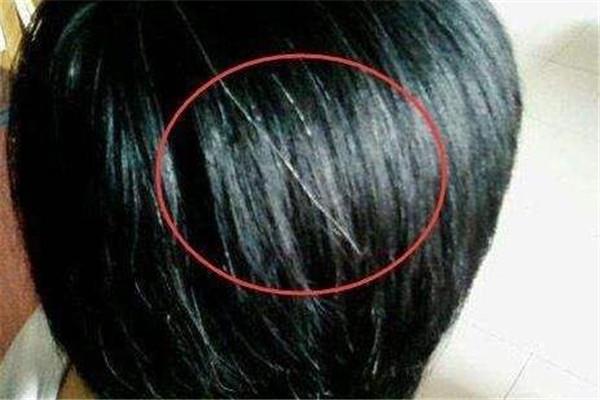 白头发可以拔吗 白头发解决方法