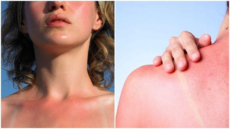 晒伤了怎么办 3段式肌肤急救