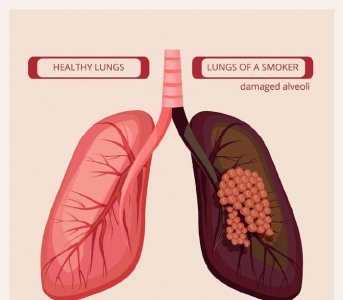 ​右肩疼竟查出肺癌晚期！身上4处疼痛千万不能忍，记得提醒咱爸妈