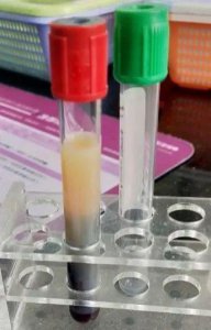 ​多吃少动，孕妈抽出了“牛奶血”