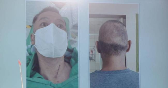 56岁汪建民透露罹患肺腺癌4期 目前已接受65次电疗