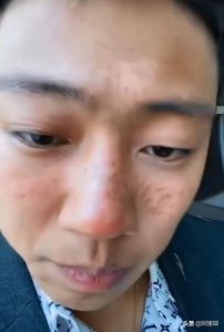 ​亿人健哥脸部晒伤否认破产跳楼