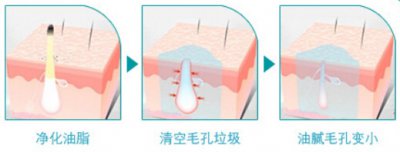 ​全身光子 有人做过光子嫩肤吗，全身光子嫩肤多少钱，路过的进来看看！