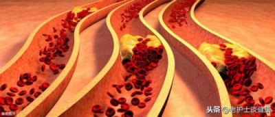 ​高血脂的治疗方法_高血脂的治疗原则