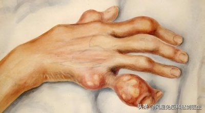 ​痛风必看！痛风石是如何一步步形成？附科学防治指南！